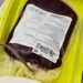 Pessoas com sangue tipo A são mais propensas a ter AVC antes dos 60 anos, diz estudo
