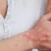 Dermatologistas do Paraná promovem campanha de alerta contra dermatite atópica