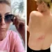 Ana Hickmann cai de cavalo e mostra hematoma: ‘Não quebrei nada mas dor continua’