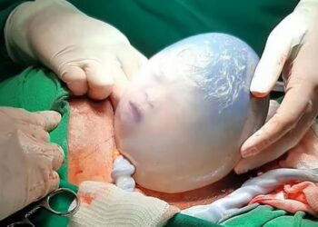 Parto raro com bebê empelicado emociona em Hospital do Pará
