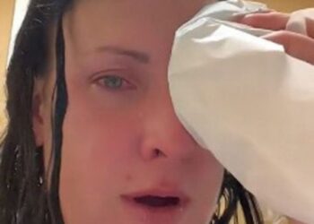 Mulher fecha os olhos com cola após confundir frasco com colírio