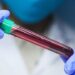 Chega ao Brasil 1º exame de sangue que detecta Alzheimer; como funciona